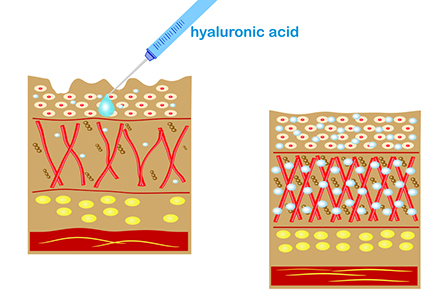 Tipuri de acid hialuronic
