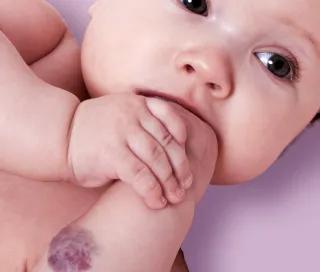 Hemangiom la bebelusi – din ce cauze apare si cum poate fi tratat