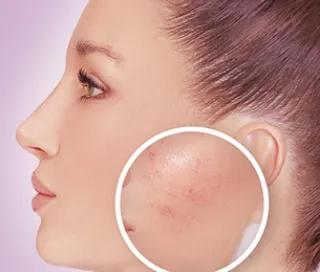 Informatii despre rozacee - cauze si tratament